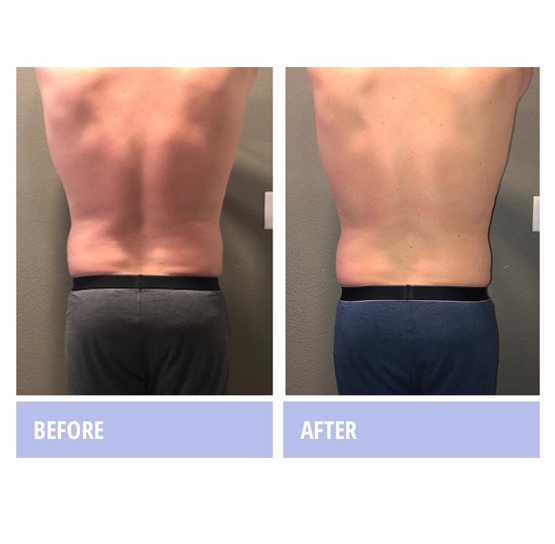 Zerona Male Body Before and After