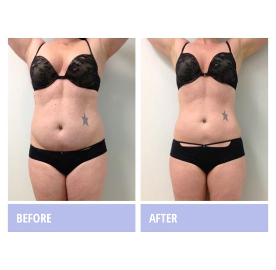 Zerona Before and After